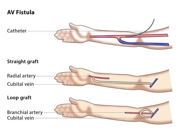 Difference Between Fistula and Shunt