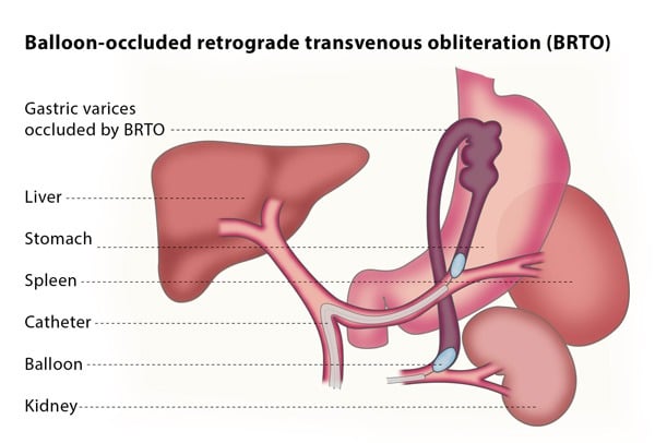 Balloon Occluded Retrograde Transvenous Obliteration Brto Cirse