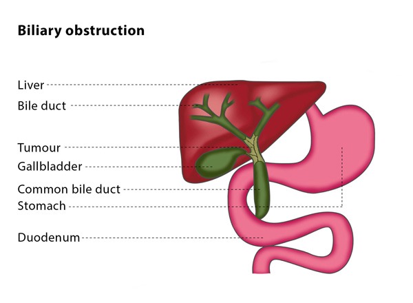 Percutaneous Cholecystostomy (Gallbladder) Drainage Interventional  Radiology | Treatments | Patients & Families | UW Health