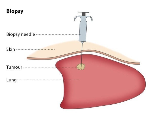 Biopsy – CIRSE