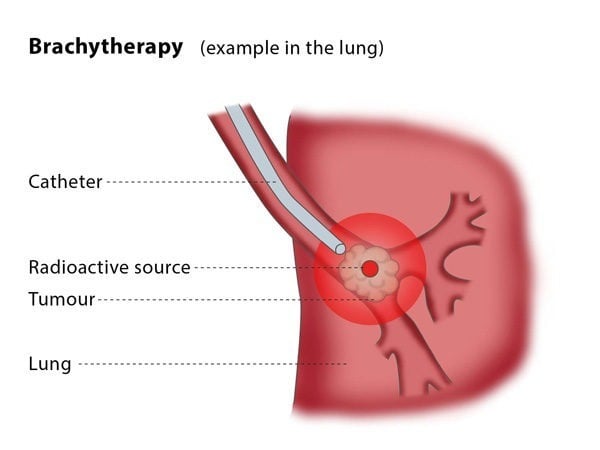 Brachytherapy – CIRSE