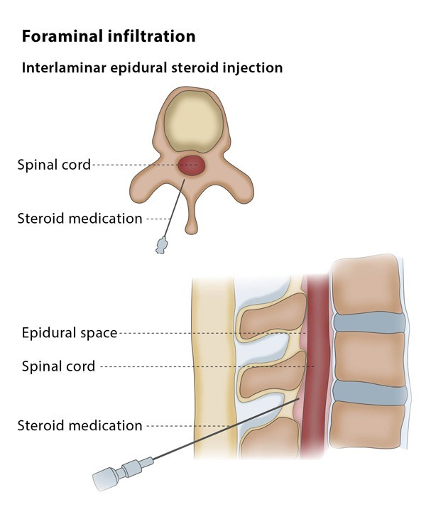 Infiltration Injection Route Infiltrations and guided injections