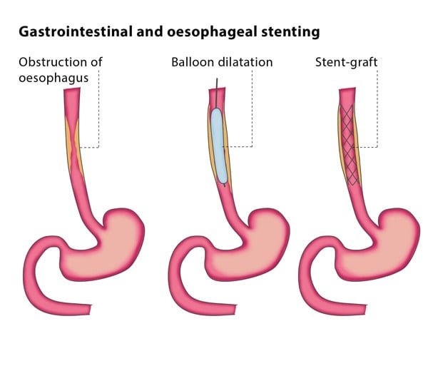 Gastrointestinal And Oesophageal Stenting Cirse