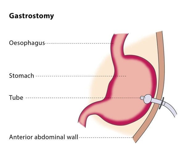 gastrostomy bag