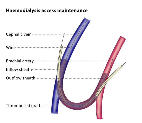 Haemodialysis Access Maintenance Cirse