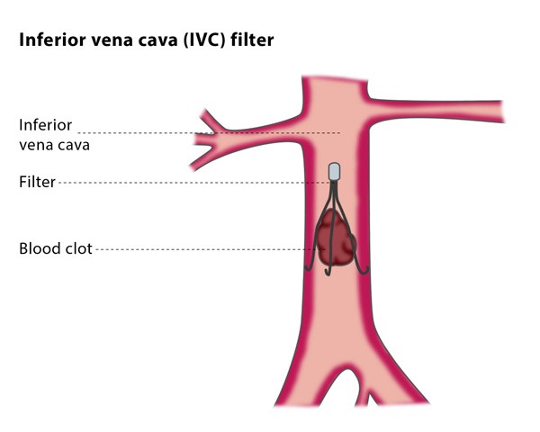 Inferior Vena Cava IVC Filters Placement And Retrieval Inferior Vena Cava IVC Filters Placement And Retrieval
