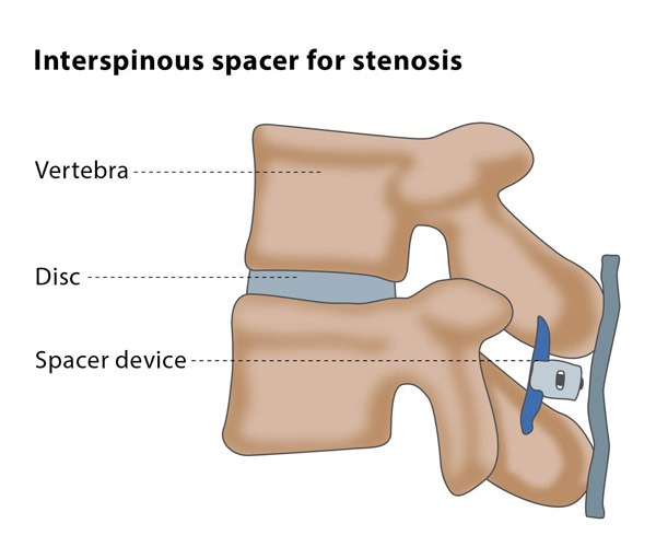 Percutaneous therapies for spinal stenosis CIRSE