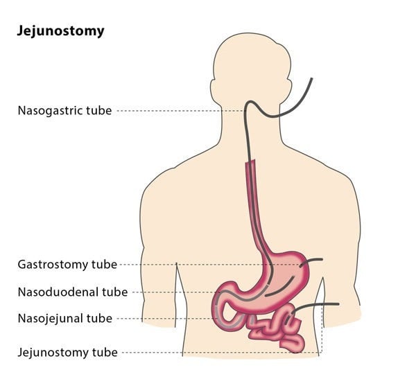 Jejunostomy Cirse