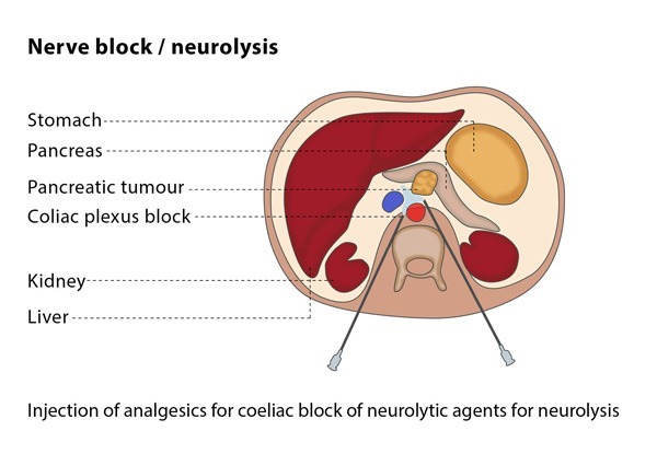Neurolysis And Plexus Infiltrations Cirse