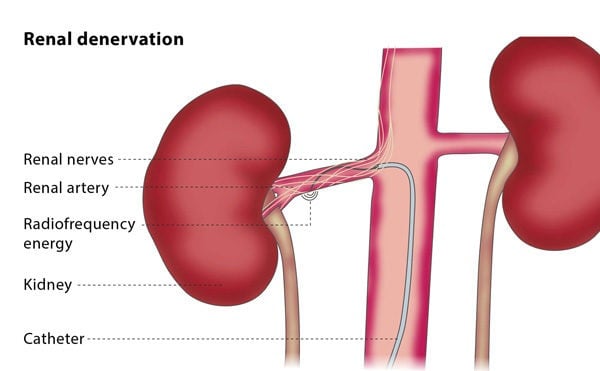 Renal denervation CIRSE