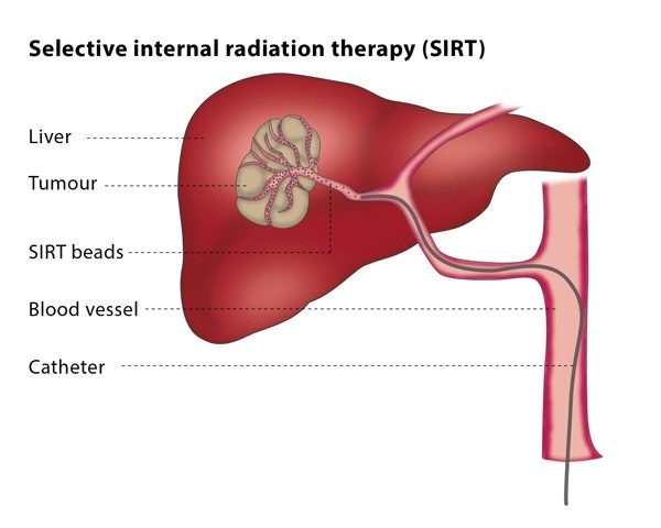 cancer hepatic treatment)