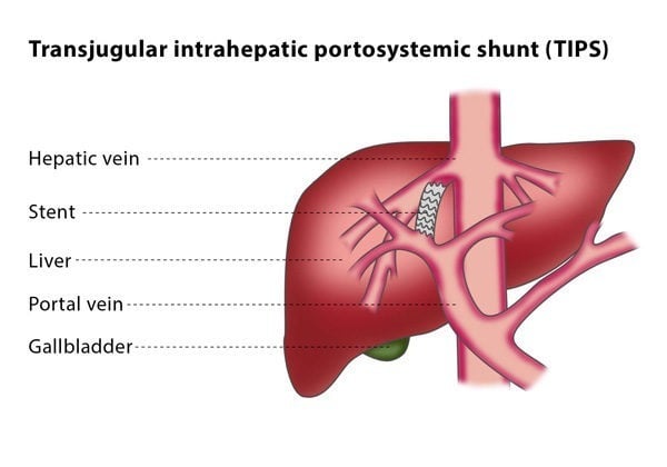 Transjugular Intrahepatic Portosystemic Shunt Tips Cirse