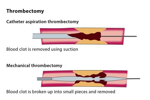 Mechanical Thrombectomy in Nighttime Hours: Is There a Difference