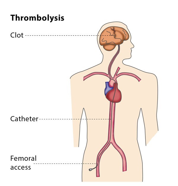 Thrombolysis CIRSE
