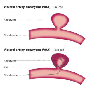 Endovascular treatment of visceral aneurysms