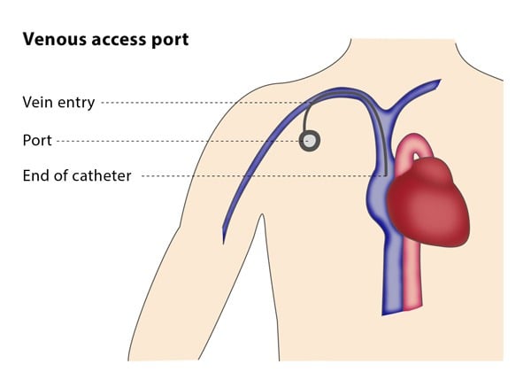 Venous access ports – CIRSE