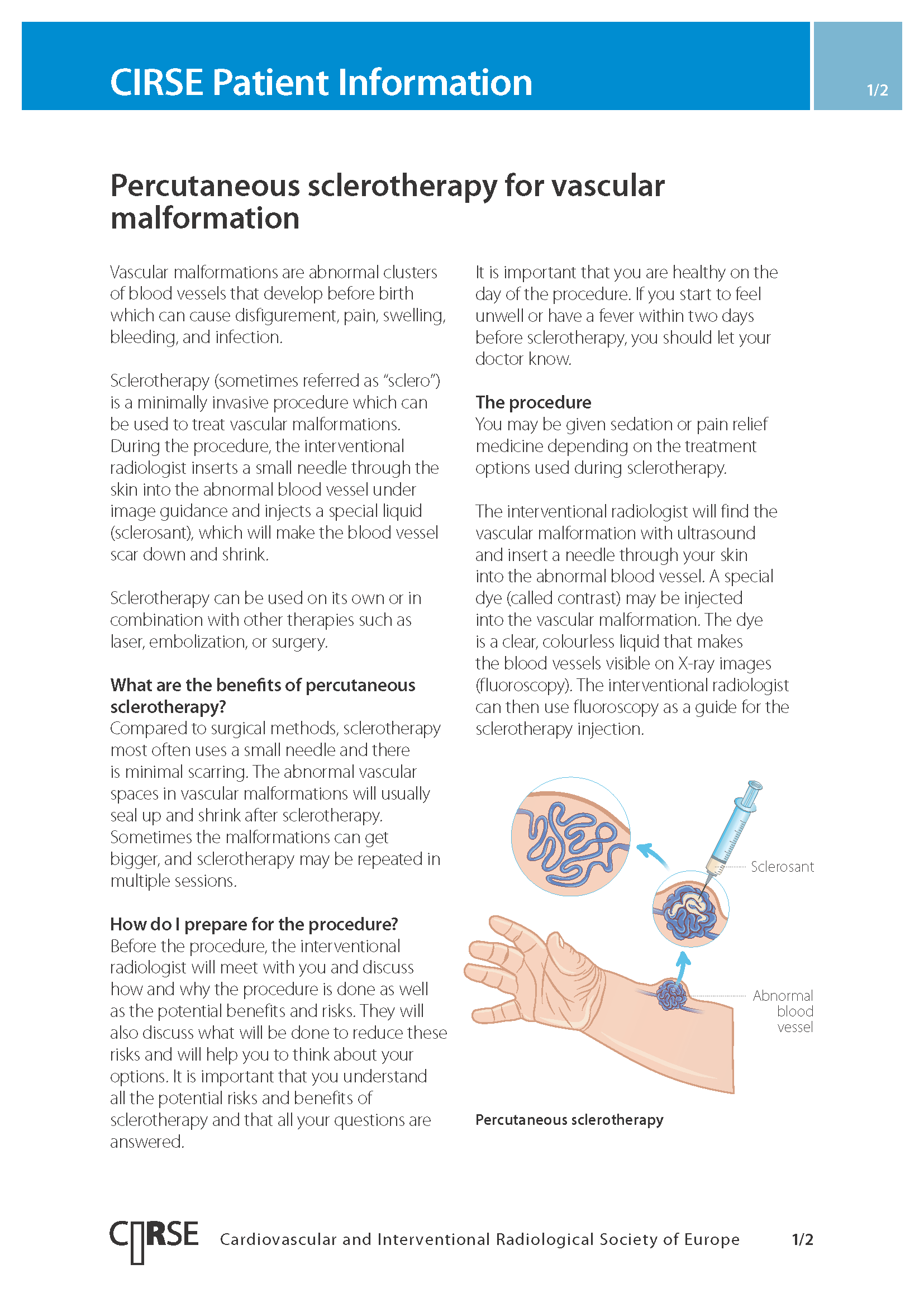 Percutaneous sclerotherapy for vascular malformation