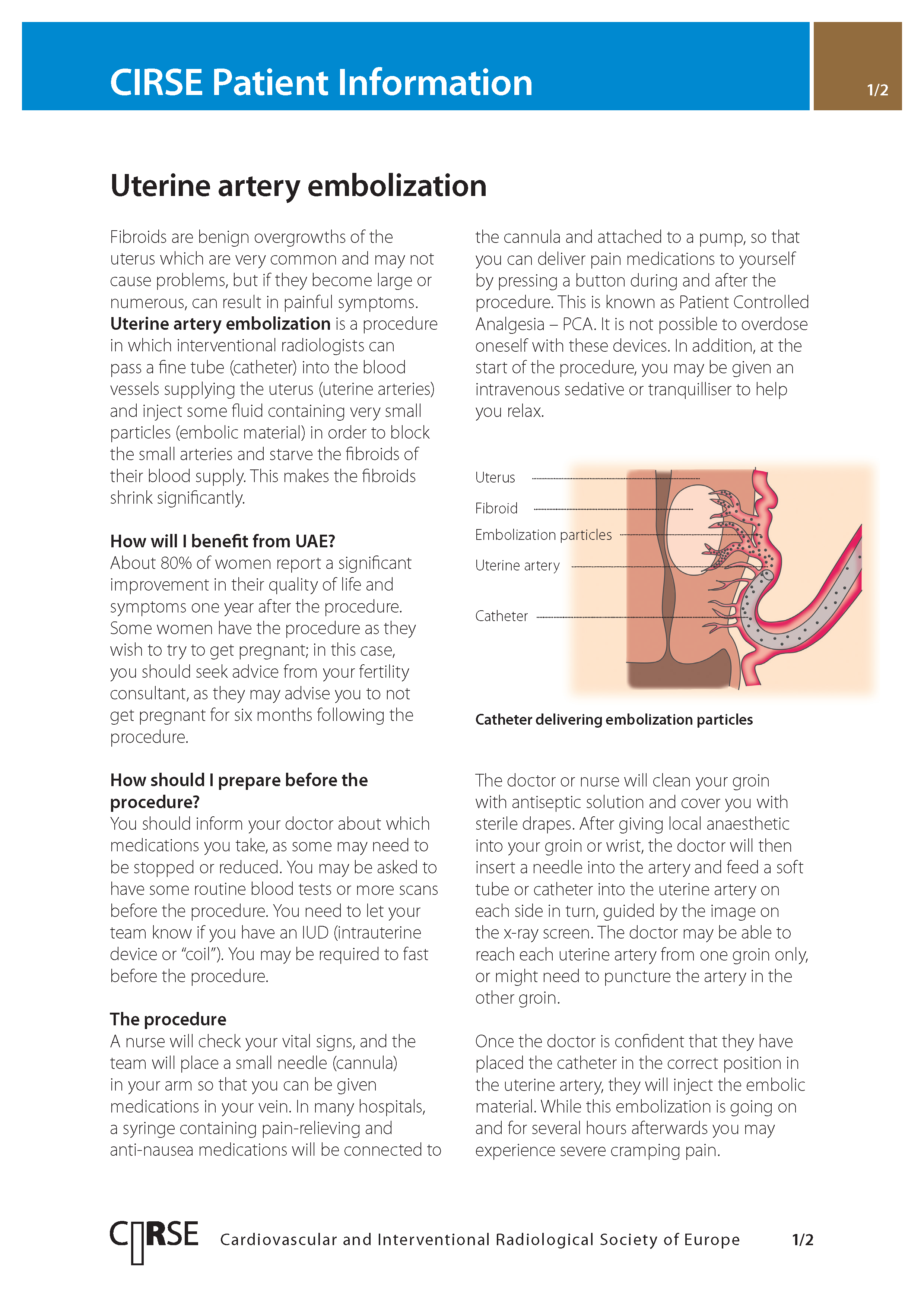 Uterine artery embolisation