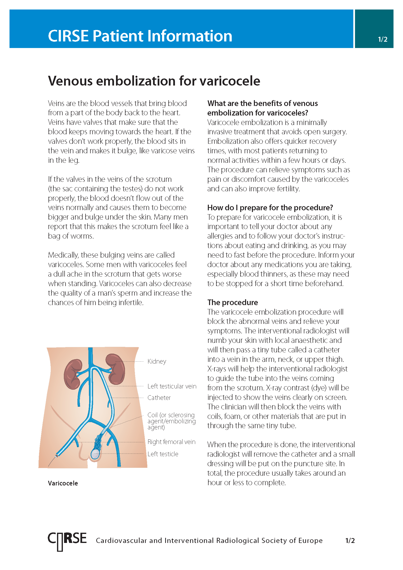 Venous embolization for varicocele