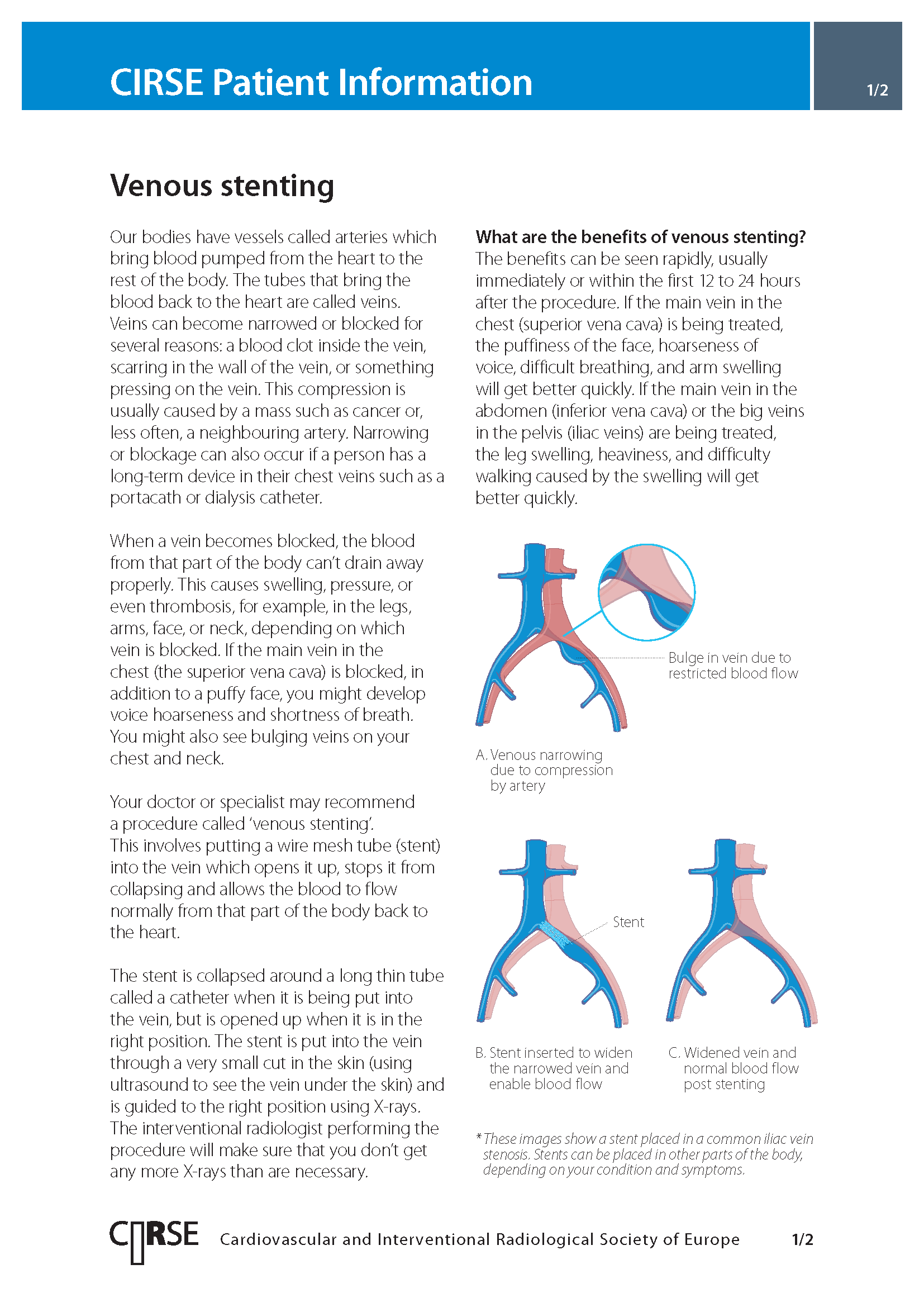Venous stenting